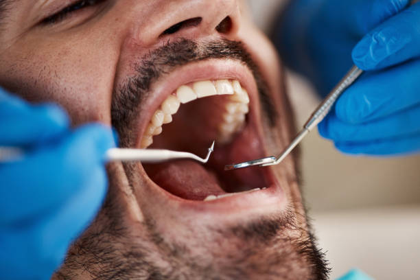 Best Emergency Dentist for Lost Fillings or Crowns in New Madison, OH
